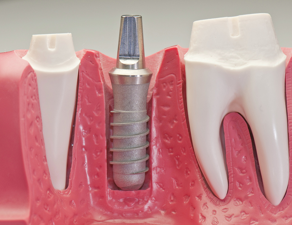 IMPLANT-AND-SURGERY