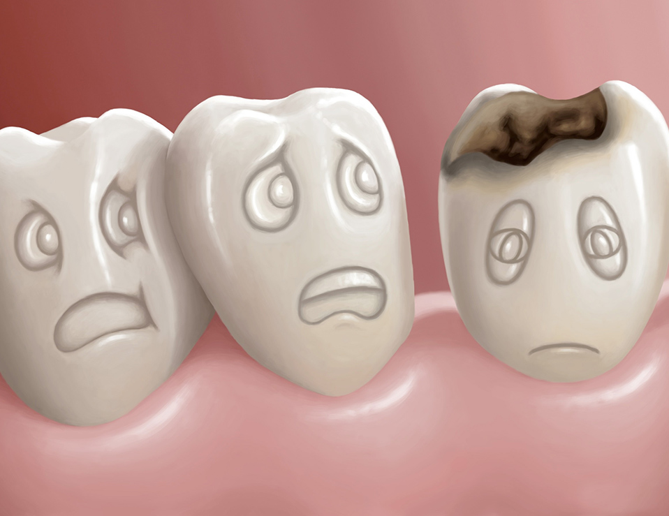 Tooth-Decay