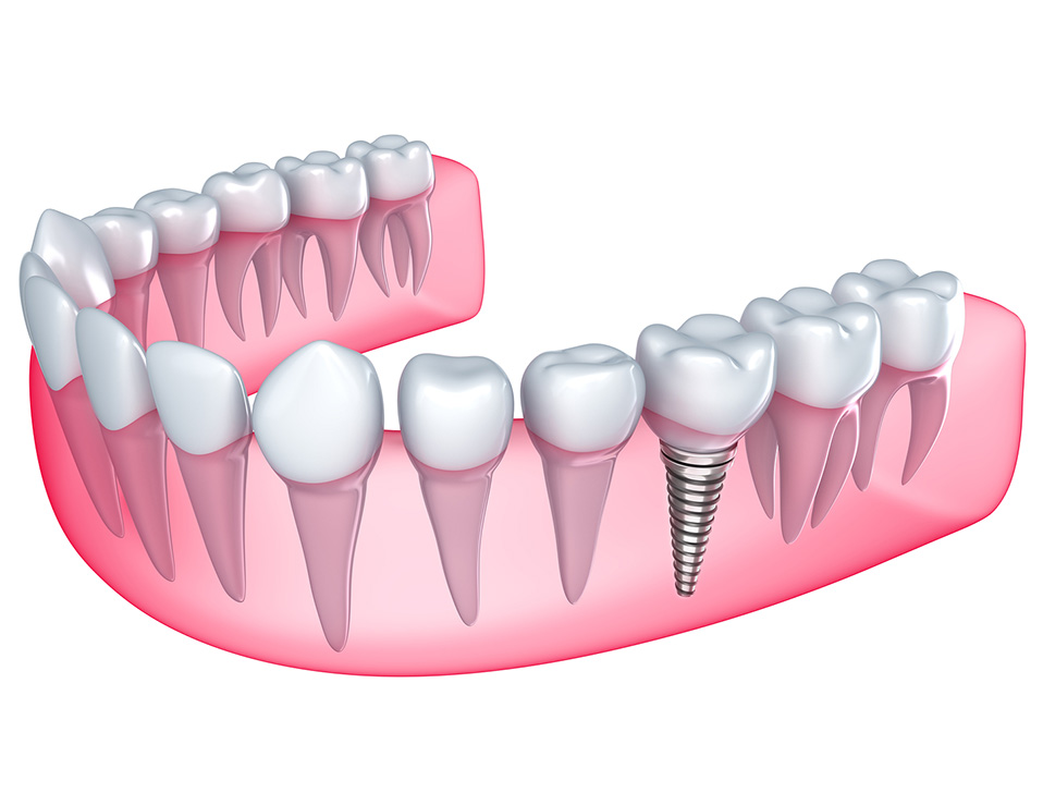 Dental-implant